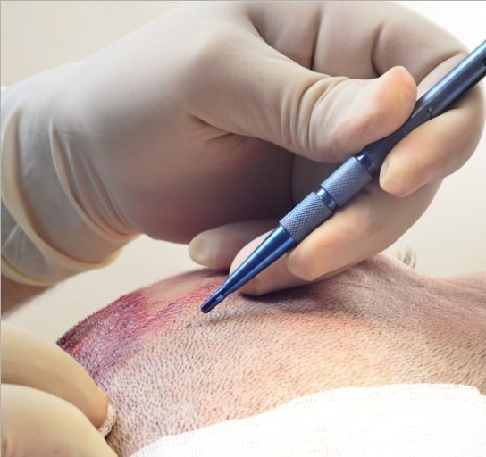 Fue Haartransplantatie Behandeling - nr. 1