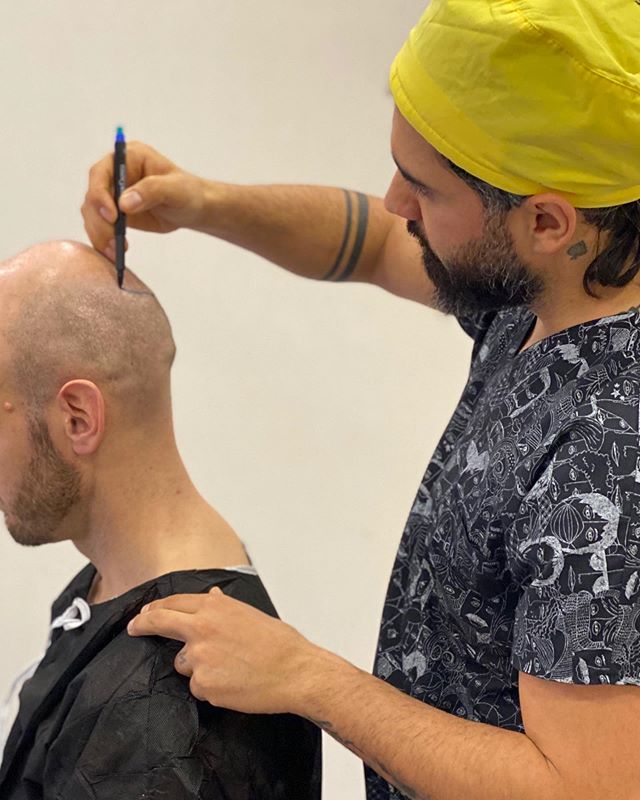 Fue Haartransplantatie Behandeling - Afbeelding 3
