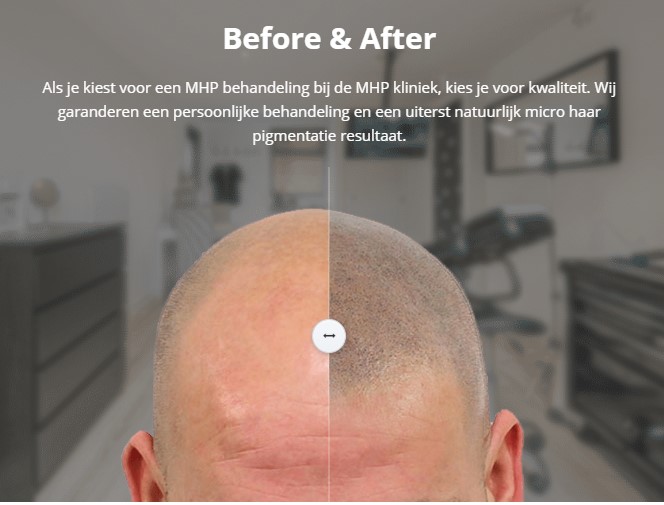 Micro Hair Pigmentation - MHP kliniek - nr. 1