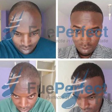 FUE Haartransplantatie - nr. 1
